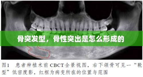骨突发型，骨性突出是怎么形成的 
