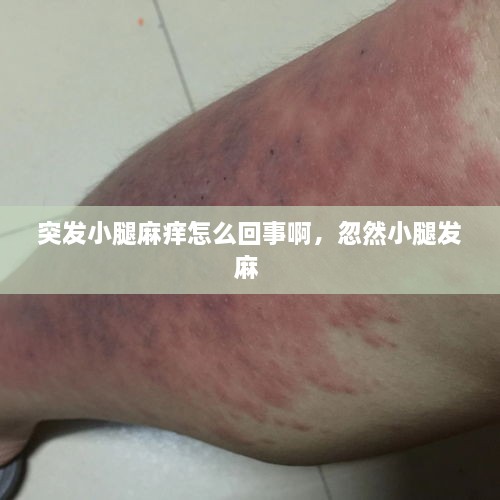 突发小腿麻痒怎么回事啊，忽然小腿发麻 